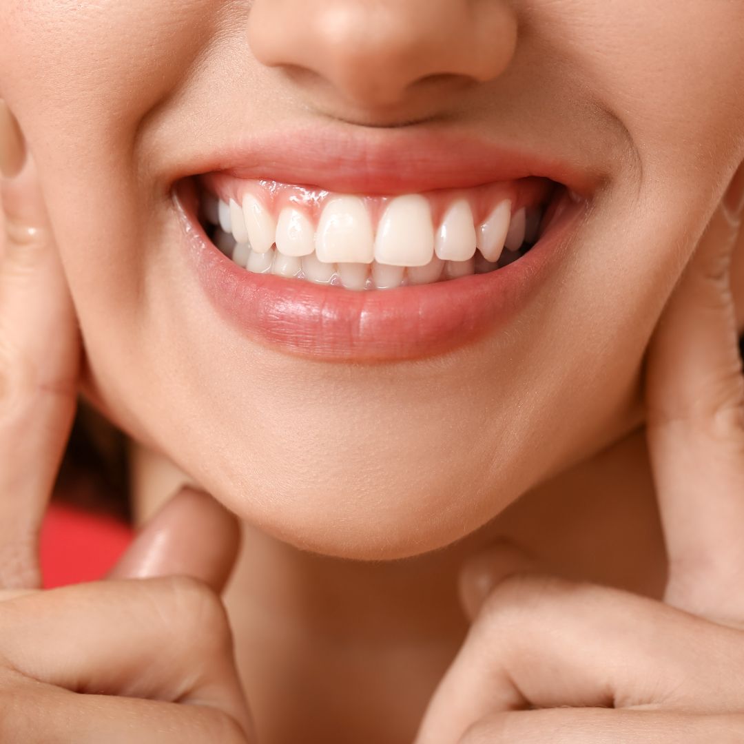 Laser Gum Contouring aesthetics