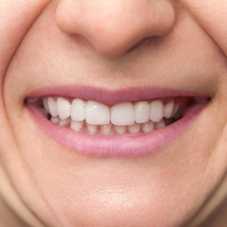 After Laser Teeth Whitening
