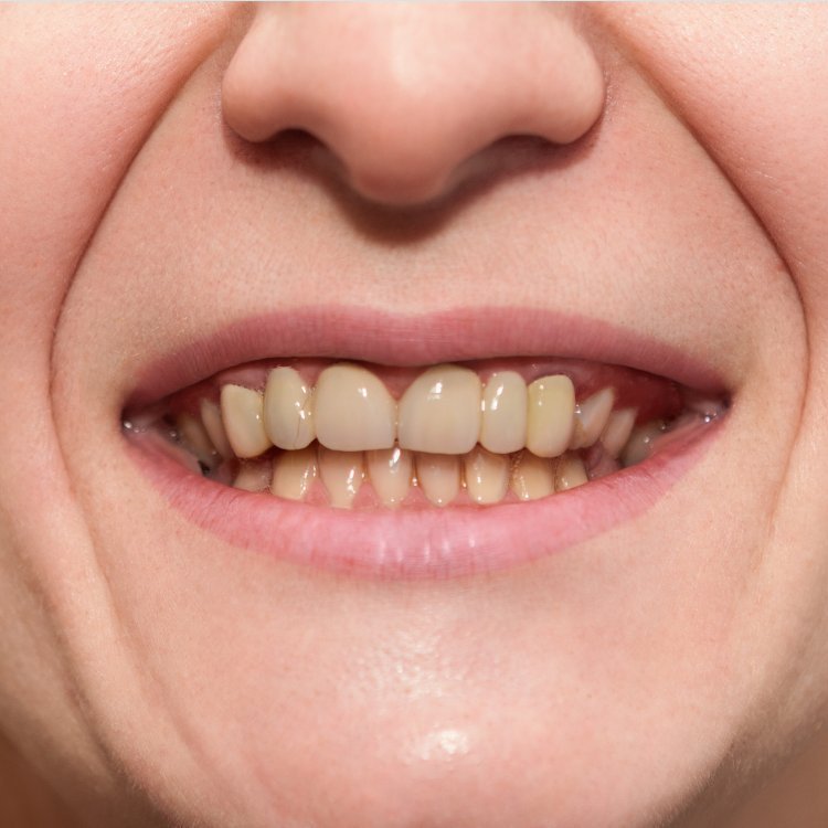 Before Laser Teeth Whitening
