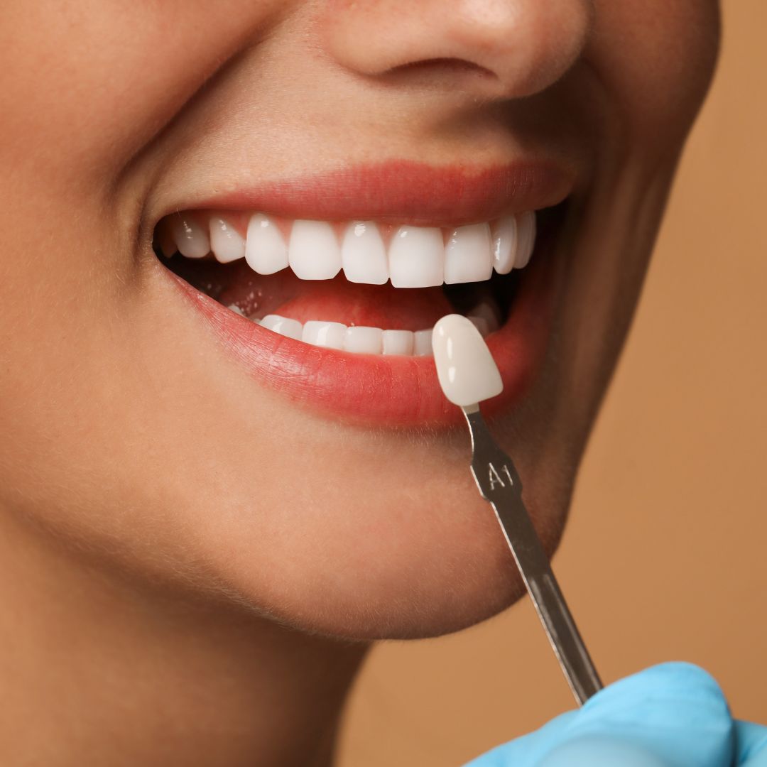 Perfect white teeth veneers