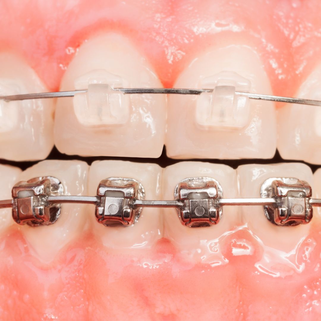 Traditional and Ceramic Braces